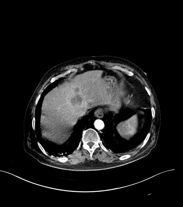 Cholangiocarcinoma with cerebral metastases (Radiopaedia 83519-98629 B 10).jpg