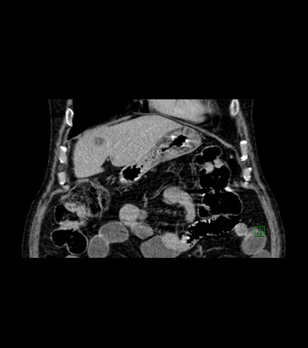 Cholangiocarcinoma with cerebral metastases (Radiopaedia 83519-98629 Coronal C+ delayed 21).jpg