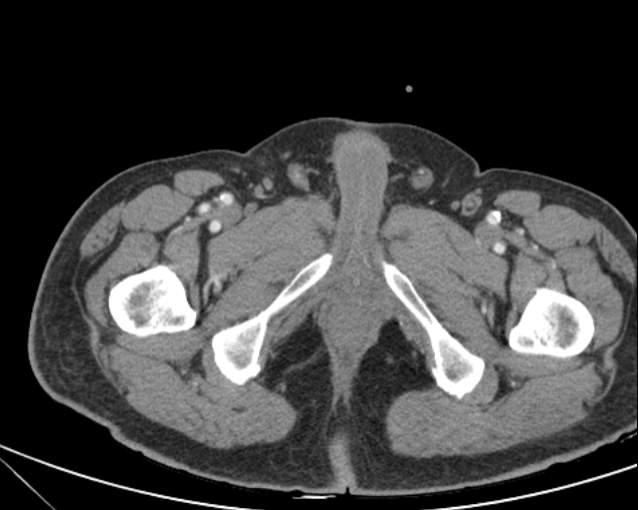 File:Cholecystitis - perforated gallbladder (Radiopaedia 57038-63916 A 86).jpg