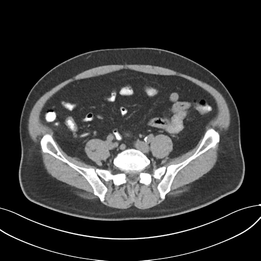 File:Cholecystitis with focal perforation and hepatic abscess (Radiopaedia 37189-38945 Axial non-contrast 60).png