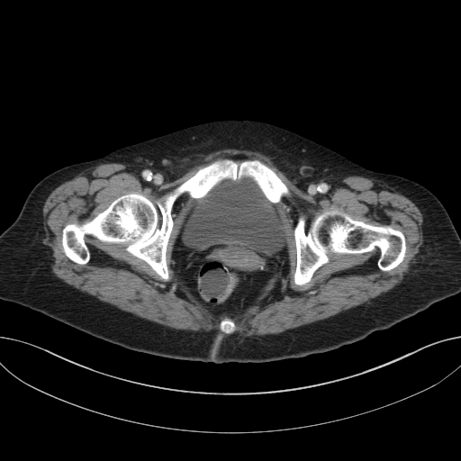 Cholecystoduodenal fistula due to calculous cholecystitis with gallstone migration (Radiopaedia 86875-103077 D 78).jpg