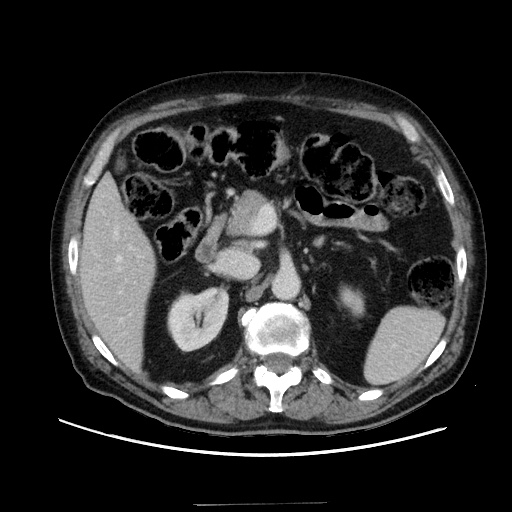 Choledocholiathiasis with normal caliber common bile duct (Radiopaedia 75368-86632 A 70).jpg