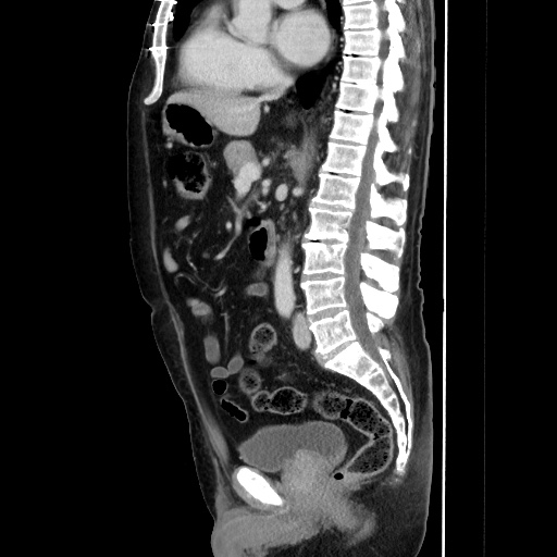 Choledocholiathiasis with normal caliber common bile duct (Radiopaedia 75368-86632 D 85).jpg