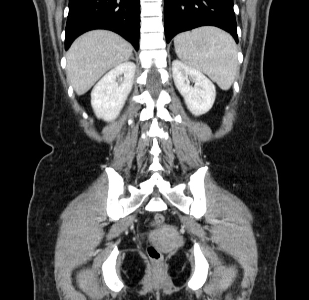 Choledocholithiasis on CT and MRI (Radiopaedia 24825-25087 C 39).jpg