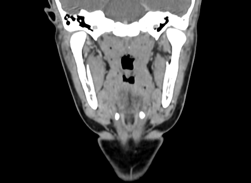 Chondroblastic osteosarcoma (Radiopaedia 67363-76741 D 62).jpg