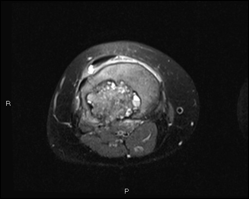 File:Chondroblastoma (Radiopaedia 62721-71031 Axial PD fat sat 23).jpg