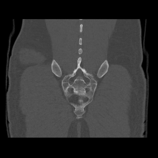 Chondrosarcoma of iliac wing (Radiopaedia 63861-72599 Coronal bone window 98).jpg