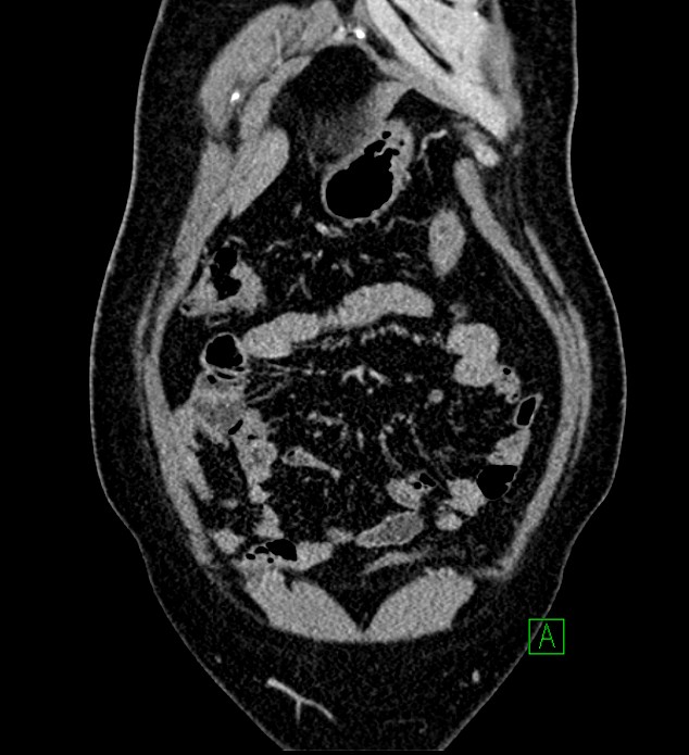 Chromophobe renal cell carcinoma (Radiopaedia 84286-99573 H 33).jpg