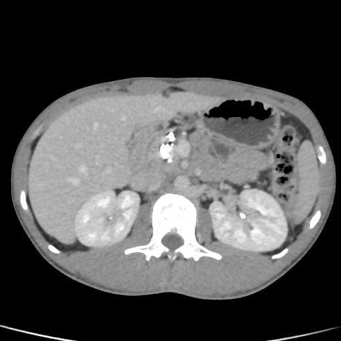 File:Chronic calcific pancreatitis (Radiopaedia 56280-62953 C 16).jpg