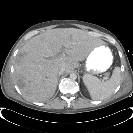 Chronic diverticulitis complicated by hepatic abscess and portal vein thrombosis (Radiopaedia 30301-30938 A 23).jpg