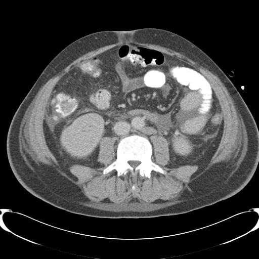 Chronic diverticulitis complicated by hepatic abscess and portal vein thrombosis (Radiopaedia 30301-30938 A 54).jpg