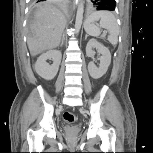 Chronic diverticulitis complicated by hepatic abscess and portal vein thrombosis (Radiopaedia 30301-30938 B 39).jpg