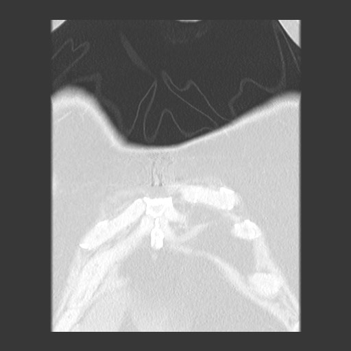 File:Chronic lung allograft dysfunction - restrictive form (Radiopaedia 60595-68316 Coronal lung window 16).jpg