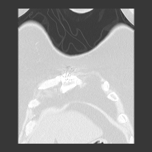 Chronic lung allograft dysfunction - restrictive form (Radiopaedia 60595-68316 Coronal lung window 19).jpg