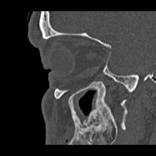 Chronic maxillary sinusitis (Radiopaedia 27879-28116 Sagittal bone window 44).jpg