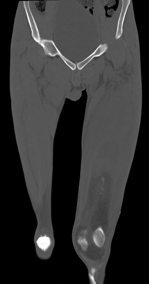 Chronic osteomyelitis (with sequestrum) (Radiopaedia 74813-85822 Coronal non-contrast 16).jpg