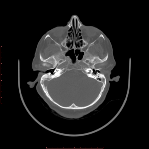 Chronic osteomyelitis - maxilla (Radiopaedia 23783-23927 Axial bone window 122).jpg