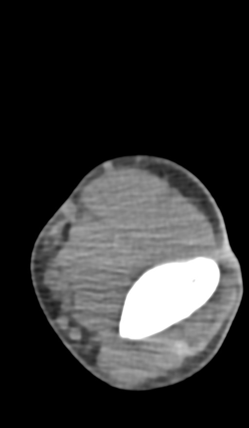 Chronic osteomyelitis of the distal humerus (Radiopaedia 78351-90971 Axial non-contrast 80).jpg