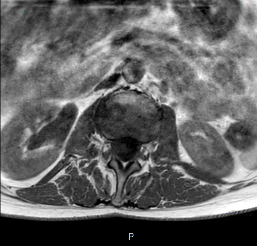 File:Chronic spinal hematoma with cauda equina syndrome (Radiopaedia 75745-87090 Axial T1 7).png