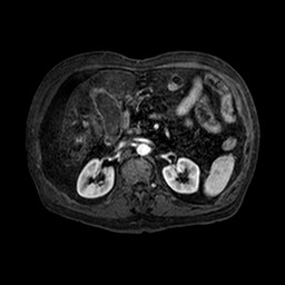 Cirrhosis and hepatocellular carcinoma in the setting of hemochromatosis (Radiopaedia 75394-86594 Axial T1 C+ fat sat 114).jpg