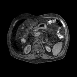 Cirrhosis and hepatocellular carcinoma in the setting of hemochromatosis (Radiopaedia 75394-86594 Axial T1 C+ fat sat 37).jpg