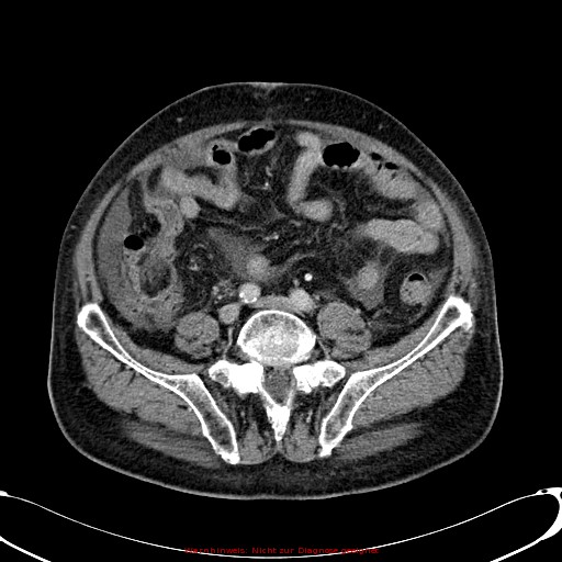 Cirrhosis and hepatocellular carcinoma in the setting of hemochromatosis (Radiopaedia 75394-86595 B 61).jpg