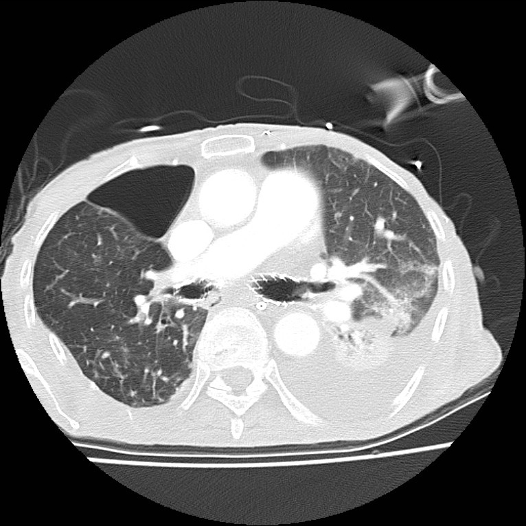 Clagett thoracotomy with bronchopleural fistula (Radiopaedia 29192-29587 Axial lung window 23).jpg