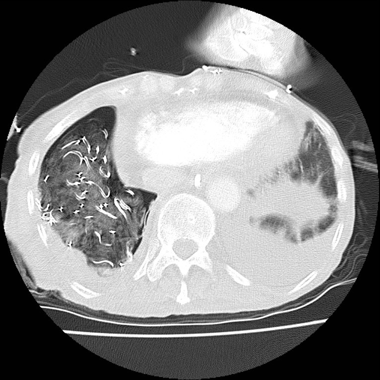 Clagett thoracotomy with bronchopleural fistula (Radiopaedia 29192-29587 Axial lung window 41).jpg