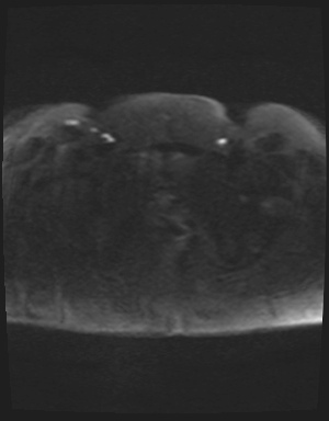 Class II Mullerian duct anomaly- unicornuate uterus with rudimentary horn and non-communicating cavity (Radiopaedia 39441-41755 Axial DWI 89).jpg