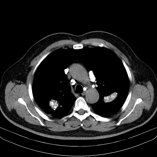 Classic complicated silicosis (Radiopaedia 49720-54961 Axial liver window 19).jpg