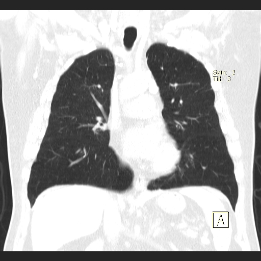 File:Classic complicated silicosis (Radiopaedia 49720-54961 Coronal lung window 28).jpg
