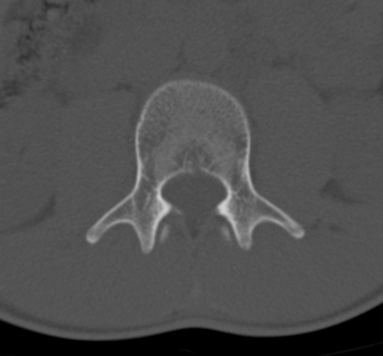 Clear cell meningoma - lumbar spine (Radiopaedia 60116-67691 Axial bone window 26).png