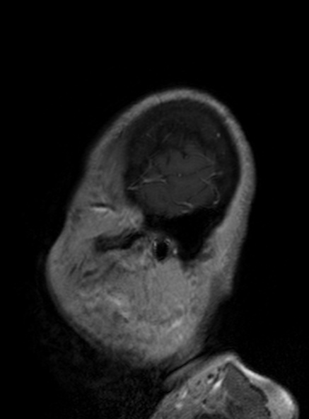 File:Clival meningioma (Radiopaedia 53278-59248 Sagittal T1 C+ 138).jpg