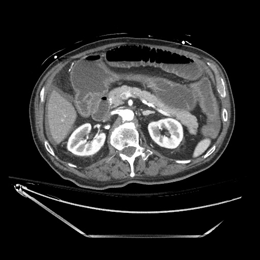 File:Closed loop obstruction due to adhesive band, resulting in small bowel ischemia and resection (Radiopaedia 83835-99023 B 55).jpg