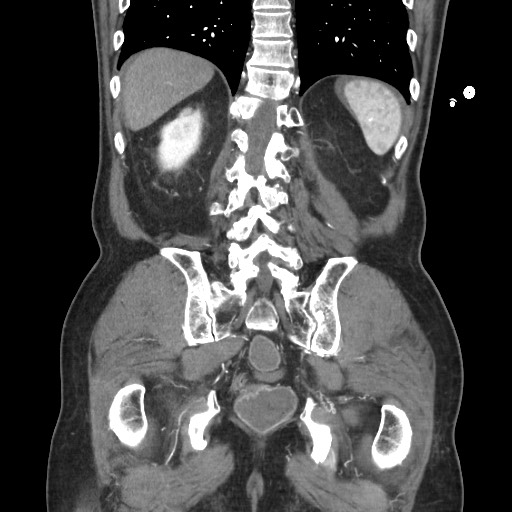 Closed loop obstruction due to adhesive band, resulting in small bowel ischemia and resection (Radiopaedia 83835-99023 C 96).jpg