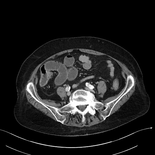 File:Closed loop small bowel obstruction - adhesions (Radiopaedia 59269-66611 Axial 24).jpg