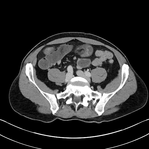 Closed loop small bowel obstruction - internal hernia (Radiopaedia 57806-64778 B 87).jpg