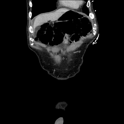 Closed loop small bowel obstruction - omental adhesion causing "internal hernia" (Radiopaedia 85129-100682 B 29).jpg