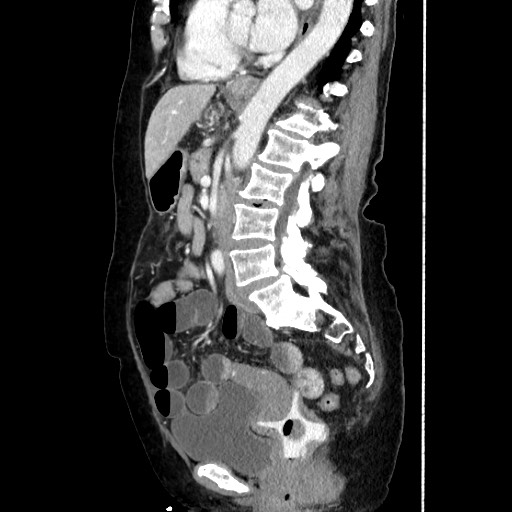 Closed loop small bowel obstruction due to adhesive band, with intramural hemorrhage and ischemia (Radiopaedia 83831-99017 D 109).jpg