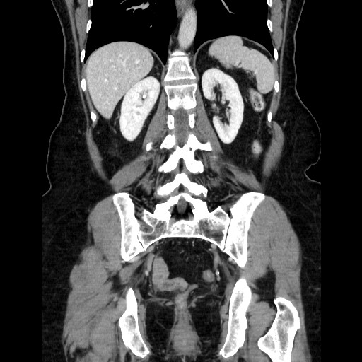Closed loop small bowel obstruction due to adhesive bands - early and late images (Radiopaedia 83830-99015 B 87).jpg