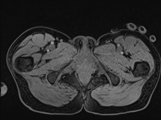 Closed loop small bowel obstruction in pregnancy (MRI) (Radiopaedia 87637-104031 G 37).jpg