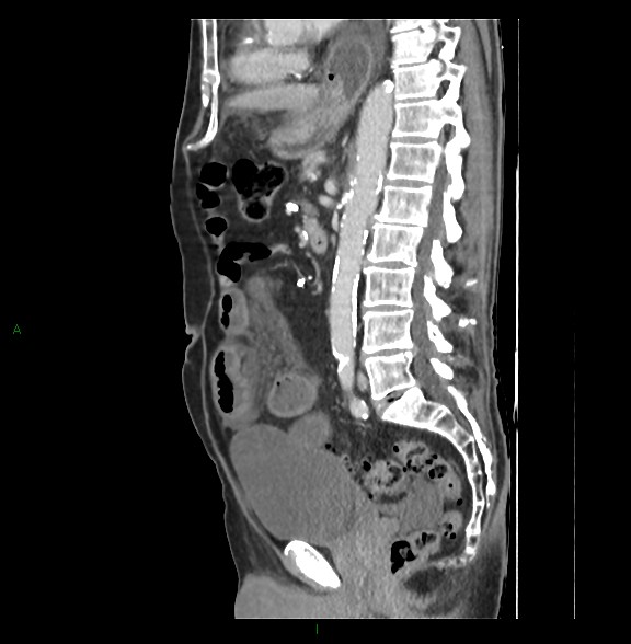 File:Closed loop small bowel obstruction with ischemia (Radiopaedia 84180-99456 C 50).jpg