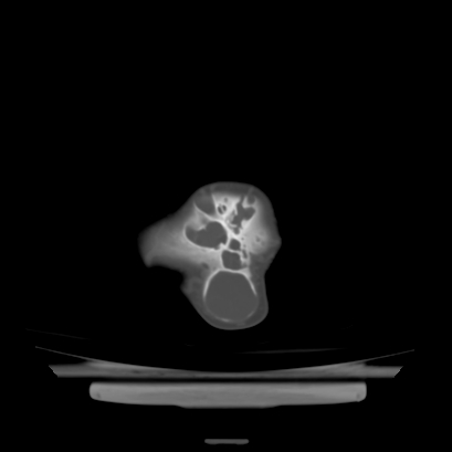 Cloverleaf skull (Radiopaedia 91901-109710 Axial bone window 139).jpg