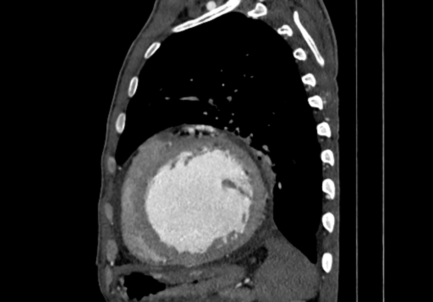 Coarctation of aorta with aortic valve stenosis (Radiopaedia 70463-80574 B 150).jpg