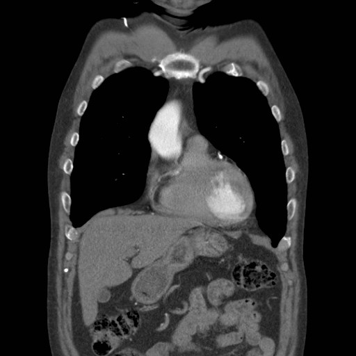 File:Coarctation of the aorta (Radiopaedia 17427-17116 A 66).jpg