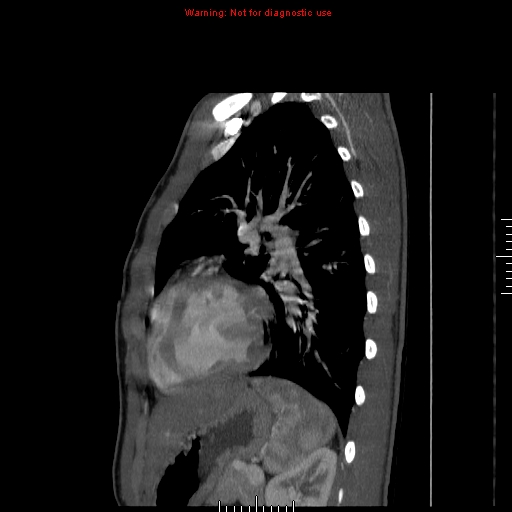 File:Coarctation of the aorta (Radiopaedia 9434-10118 B 44).jpg