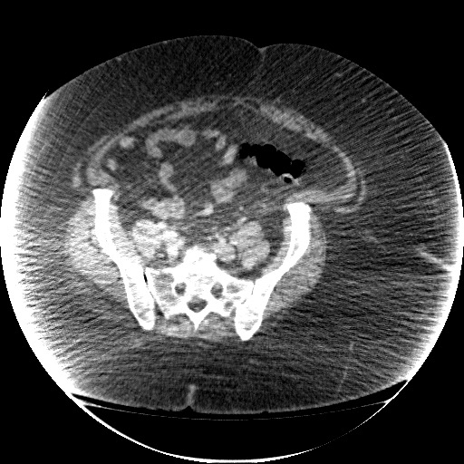 File:Collection due to leak after sleeve gastrectomy (Radiopaedia 55504-61972 A 61).jpg