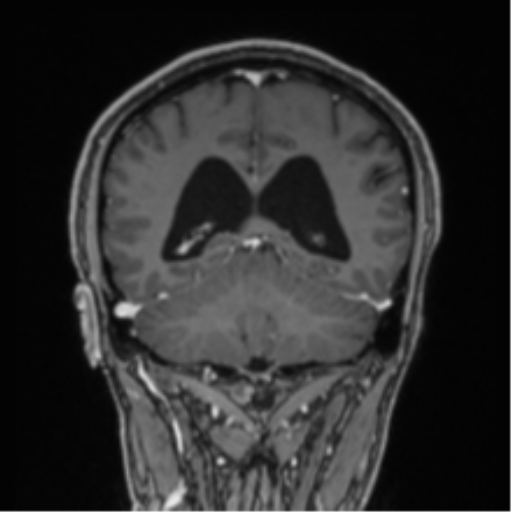 File:Colloid cyst of the third ventricle (Radiopaedia 86571-102662 Coronal T1 C+ 32).png