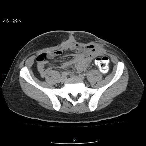 File:Colo-cutaneous fistula (Radiopaedia 40531-43129 A 41).jpg