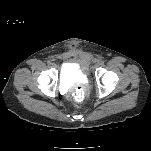 File:Colo-cutaneous fistula (Radiopaedia 40531-43129 A 85).jpg